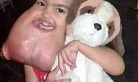 خارج کردن تومور 2 کیلویی از صورت دختربچه برزیلی
