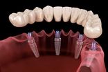 ایمپلنت فوری دندان چیست؟ + مزایا، معایب و مراحل 