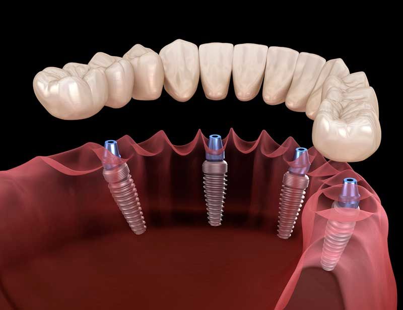 ایمپلنت فوری دندان در یک روز چیست؟ + مزایا، معایب و مراحل 
