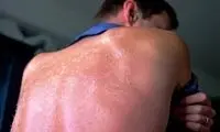 ۴نشانه مسمومیت خورشیدی