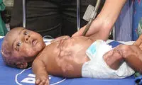 پسری که پوستش خودبه‌خود آتش می گیرد!