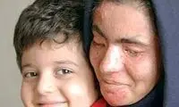 زن 33 ساله قربانی کینه اسیدی شد+عکس