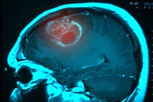 کشف علت اصلی ابتلا به سرطان مغز