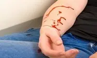 دانستنی‌هایی درباره خونریزی سیاهرگی
