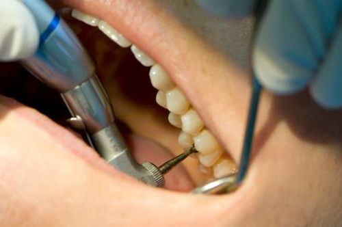دلیل درد فردای دندانپزشکی چیست؟