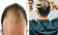 پدر یا مادر؛ کدامیک مقصر طاسی فرزندان هستند؟