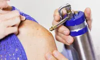 فریز کردن خال گوشتی چیست و چگونه انجام می شود؟