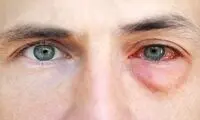 علایم چشمی ناشی از کرونا را جدی بگیرید