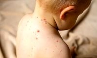 علائم آنفولانزای گوجه فرنگی را بشناسید
