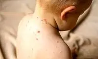 علائم آنفولانزای گوجه فرنگی را بشناسید