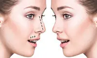 جراحی بینی طبیعی با قوس کم + شرایط و نکات مهم