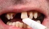 دندان سیگاری‌ها ۴ برابرِ افراد دیگر خراب می‌شود