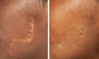 مقایسه درمان جای زخم با سلول‌های بنیادی و لیزر؛ کدام مؤثرتر است؟
