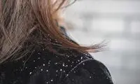 ۵ عامل اصلی شوره سر را بشناسید