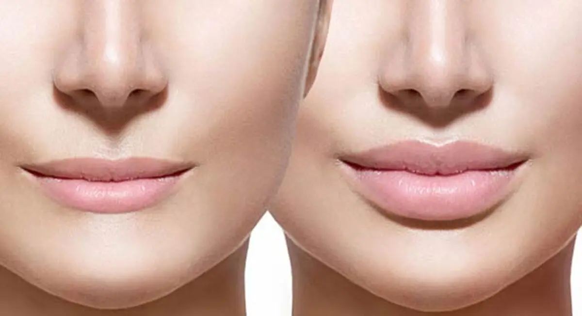بررسی 0 تا 100تزریق ژل لب