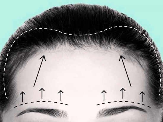 لیفت پیشانی با جراحی چگونه انجام می‌شود؟