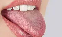 رنگ زبان شما چه هشداری درباره سلامت بدنتان می‌دهد؟