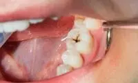 نوشیدنی‌ای که دندان سالم برای‌تان نمی‌گذارد