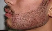 کاشت ریش و سبیل | روش ها، مراحل و هزینه کاشت ریش صورت