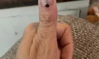 خطی روی ناخن که نشانه یک سرطان تهاجمی پوست بود