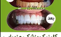 کامپوزیت ونیر در یک جلسه