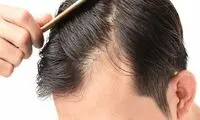 کمبود کدام ویتامین‌ها سبب ریزش مو می‌شود؟