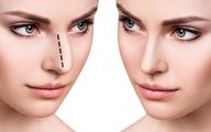 جراحی بینی بدون درد و کبودی چگونه امکان‌پذیر است؟