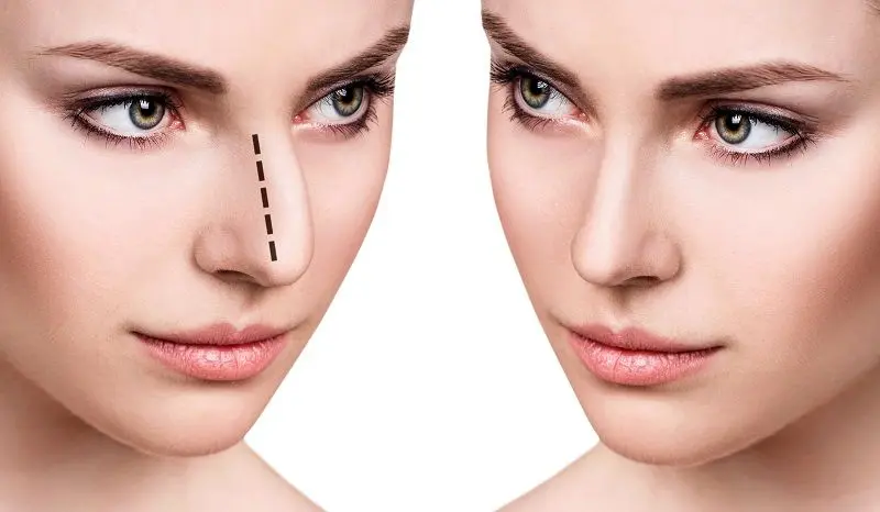 جراحی بینی بدون درد و کبودی چگونه امکان‌پذیر است؟