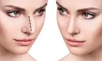 جراحی بینی بدون درد و کبودی چگونه امکان‌پذیر است؟