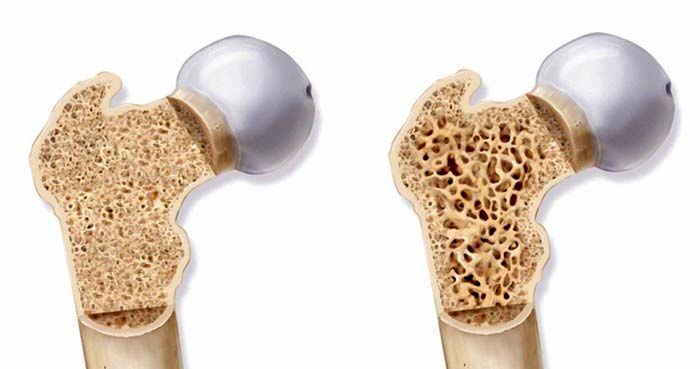 درمان پوکی استخوان فقط در ۲ هفته!