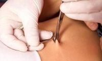 پیرسینگ ناف (Navel Piercing) چیست و چگونه انجام می‌شود؟