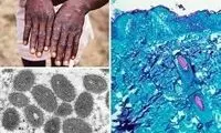 آبله میمون چه علائمی دارد و چگونه سرایت می‌کند؟