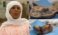 داستان زنی که نوزاد سنگی به‌دنیا آورد!