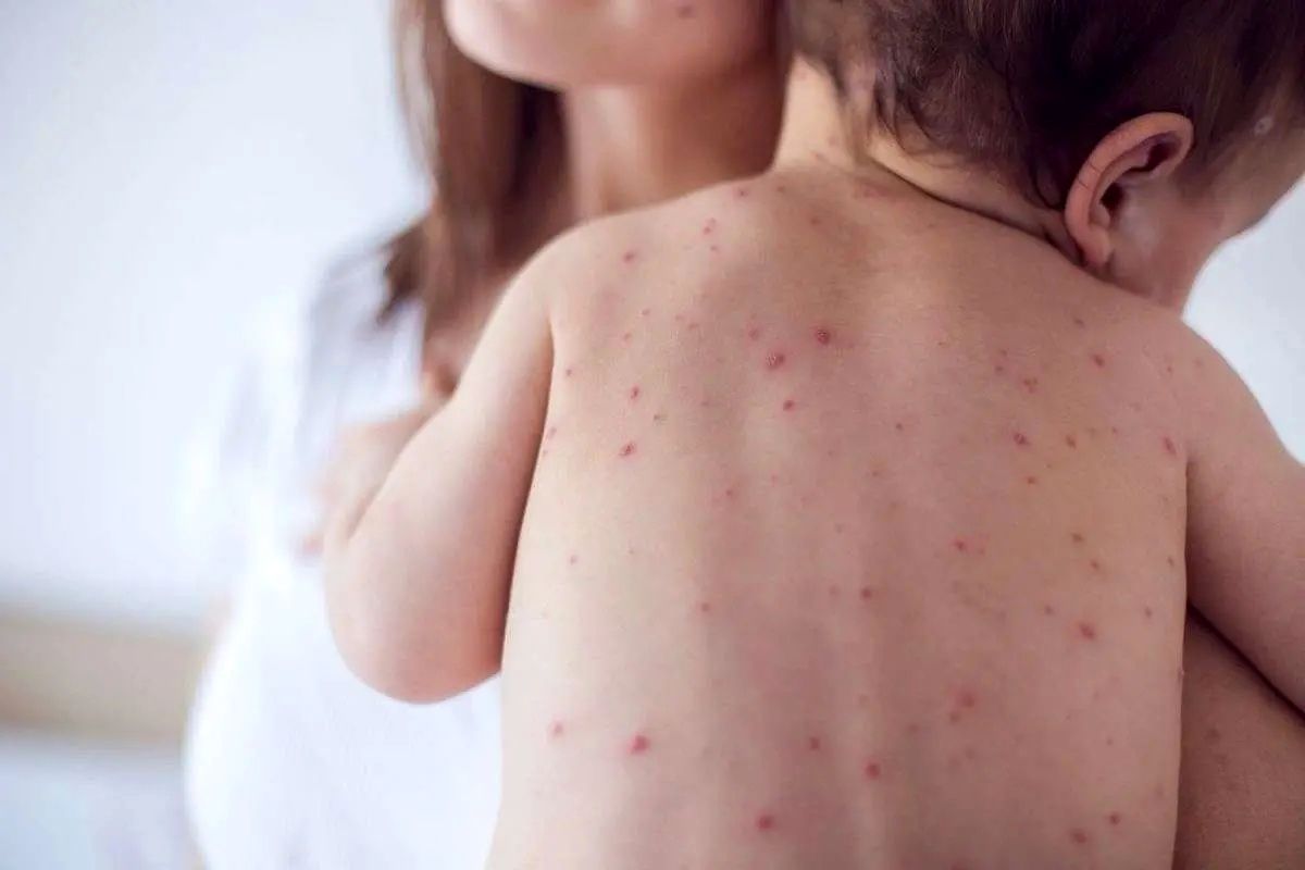   زنگ خطر شیوع مجدد سرخک به صدا درآمد 