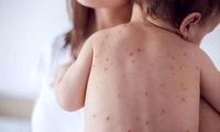 زنگ خطر شیوع مجدد سرخک به صدا درآمد