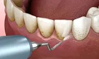 آیا جرم‌گیری دندان با جرم گیری لثه متفاوت است؟