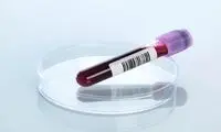 روش جدیدی برای تشخیص آلزایمر در خون