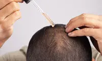 روش‌های مؤثر در جلوگیری از ریزش مو