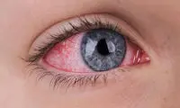 سکته چشمی چیست و چقدر خطرناک است؟