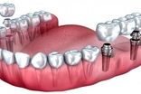ایمپلنت ارزان دندان در تهران و تفاوت آن با ایمپلنت گران