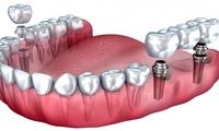 ایمپلنت ارزان دندان در تهران و تفاوت آن با ایمپلنت گران