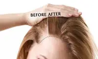 پی آر پی مو چیست و چگونه باعث درمان ریزش مو می شود؟