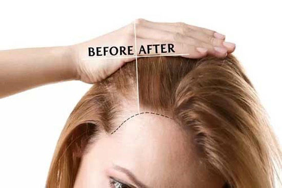 پی آر پی مو چیست و چگونه باعث درمان ریزش مو می شود؟
