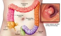 افزایش سرطان روده بزرگ در میان جوانان