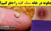 با این روش خانگی، سنگ کلیه را درمان کنید