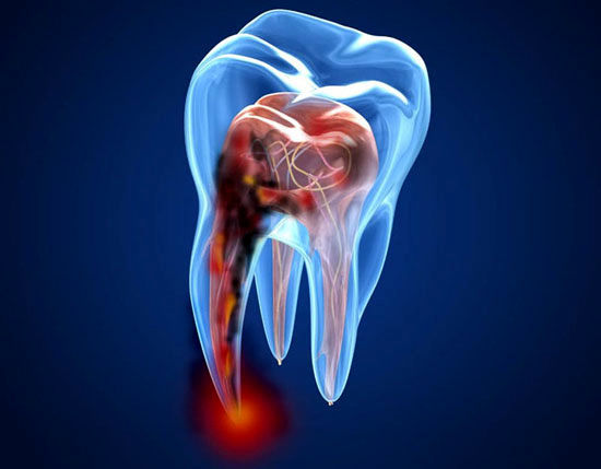 عفونت ریشه دندان چیست؟ روش‌های درمان آن را بشناسید
