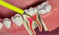 واضح‌ترین ویدئو از مراحل کامل عصب‌کشی دندان