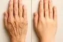 هزینه تزریق چربی به دست چقدر است؟