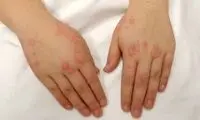 بیماری‌ای که اغلب دامن‌گیر زنان است