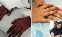 حیرت پزشکان از زنانه شدن دست‌های یک مرد!